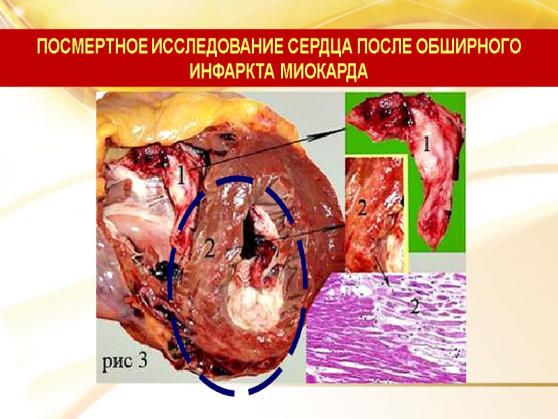 ПОСМЕРТНОЕ ИССЛЕДОВАНИЕ СЕРДЦА ПОСЛЕ ОБШИРНОГО ИНФАРКТА МИОКАРДА